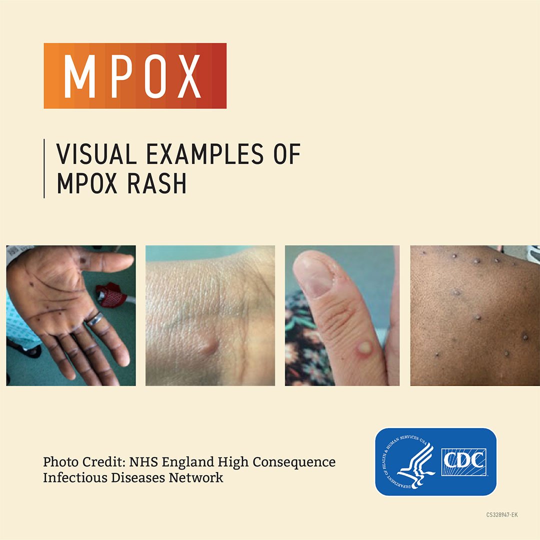 some photos of hands with strange bumps on them from monkeypox